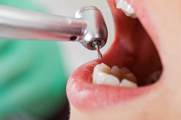Best Emergency Wisdom Teeth Removal in Lake Camelot, WI